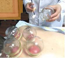 FireCupping
